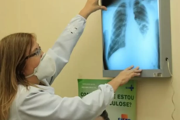 Ministério da Saúde repassa R$ 100 milhões para combate à tuberculose em 913 municípios