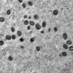 Mpox: São Paulo confirma segundo caso da doença pela nova cepa clado Ib